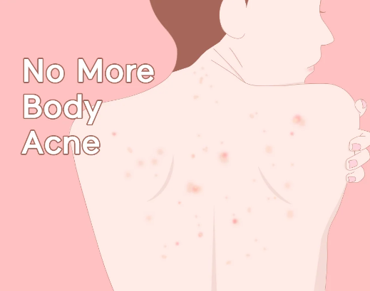 TIA'M, Anti Blemish Body Lotion Back & Chest