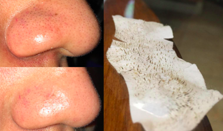  EGG PORE NOSE PACK  